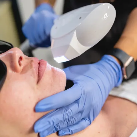 Syneron SRA