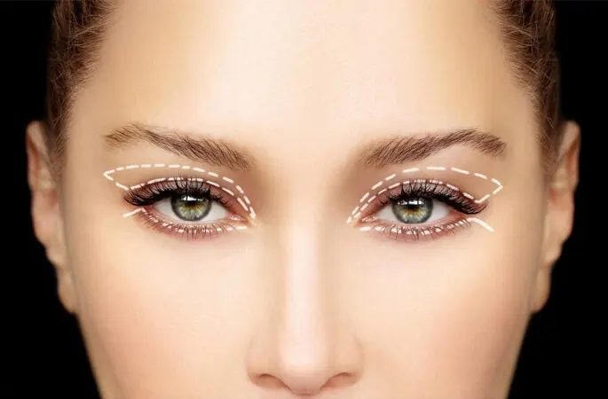 Blepharoplasty